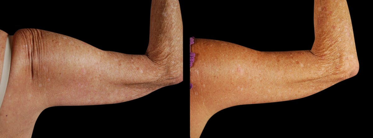 Arm Lift Before & After Gallery - Patient 919577 - Image 4