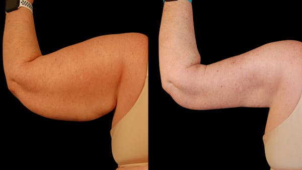 Arm Lift Before & After Gallery - Patient 141600 - Image 1