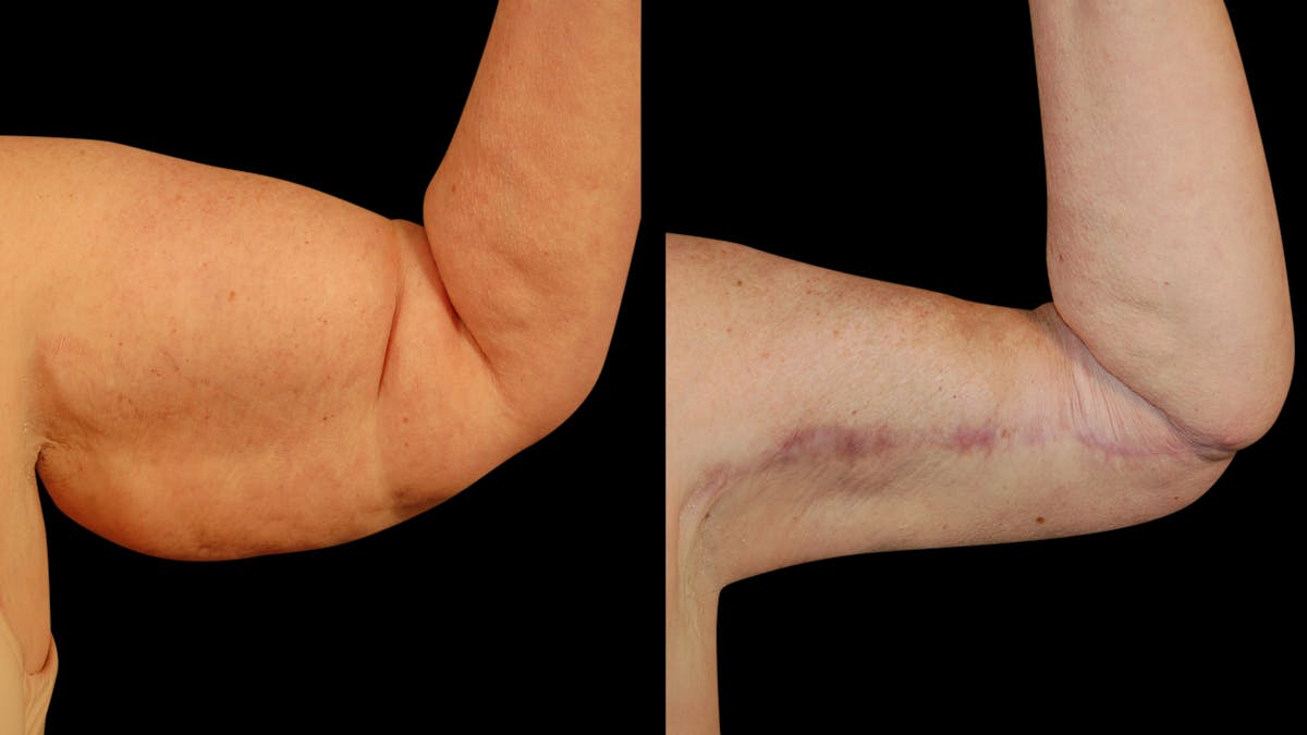 Arm Lift Before & After Gallery - Patient 141600 - Image 4