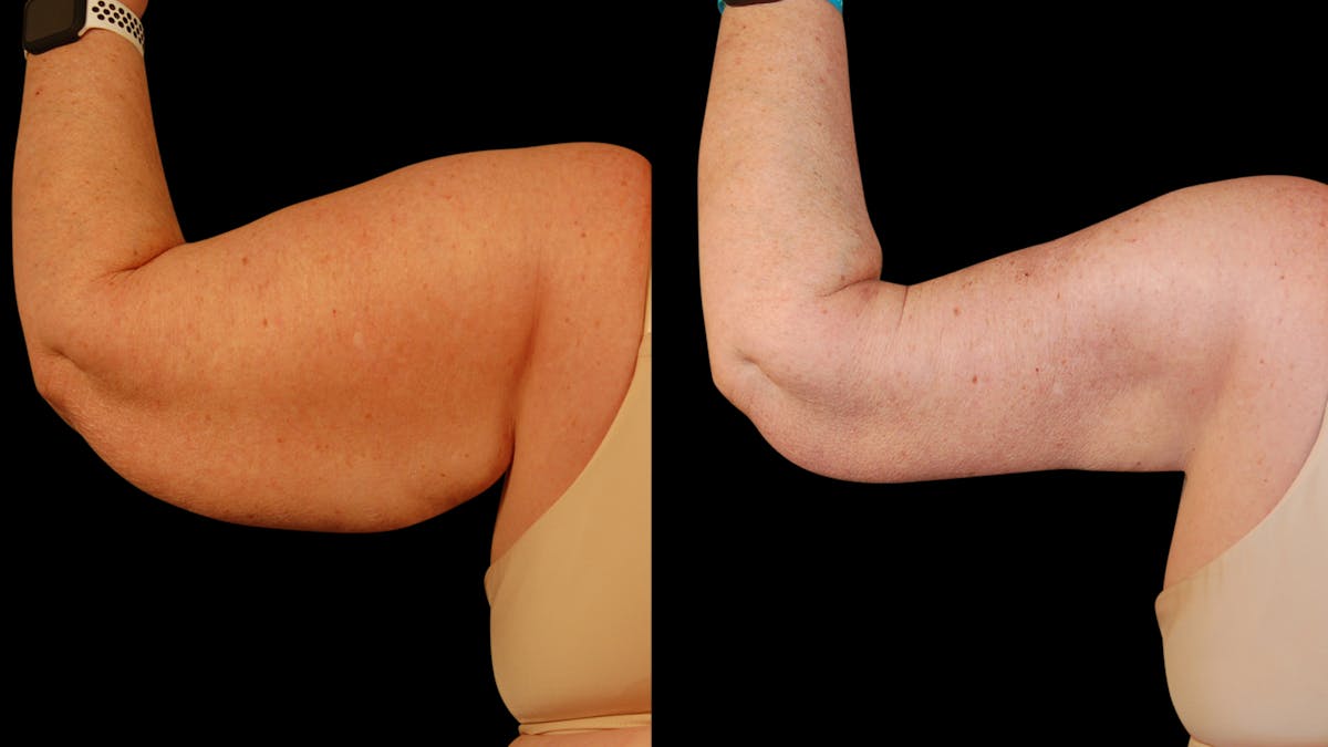 Arm Lift Before & After Gallery - Patient 141600 - Image 5