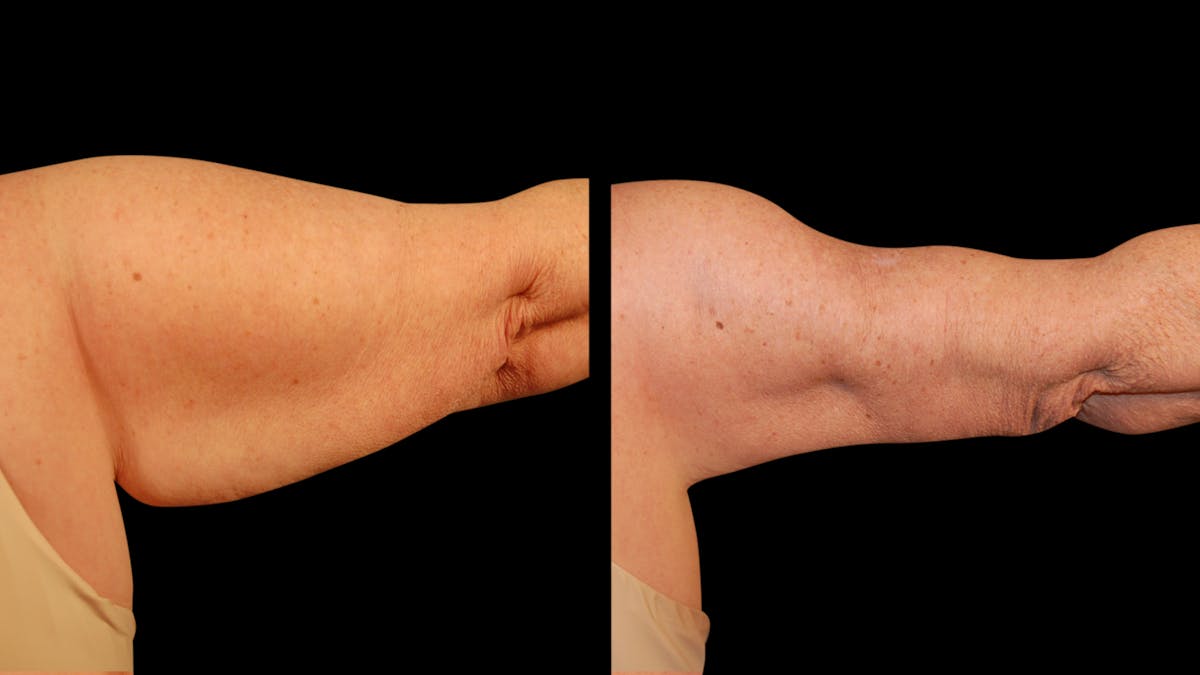 Arm Lift Before & After Gallery - Patient 141600 - Image 6
