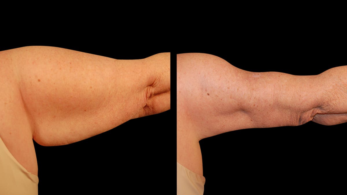 Arm Lift Before & After Gallery - Patient 141600 - Image 8