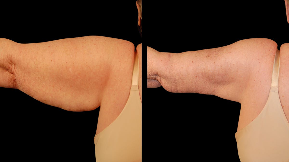 Arm Lift Before & After Gallery - Patient 141600 - Image 9