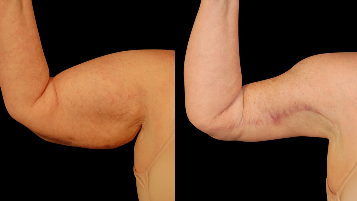 Arm Lift Before & After Gallery - Patient 141600 - Image 10