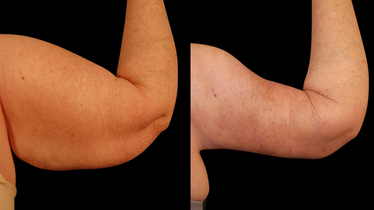 Arm Lift Before & After Gallery - Patient 141600 - Image 11