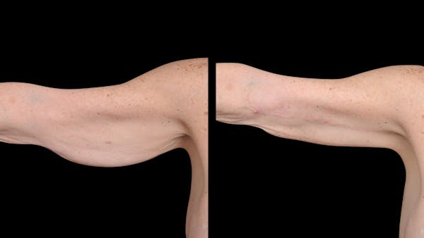 Arm Lift Before & After Gallery - Patient 263238 - Image 1