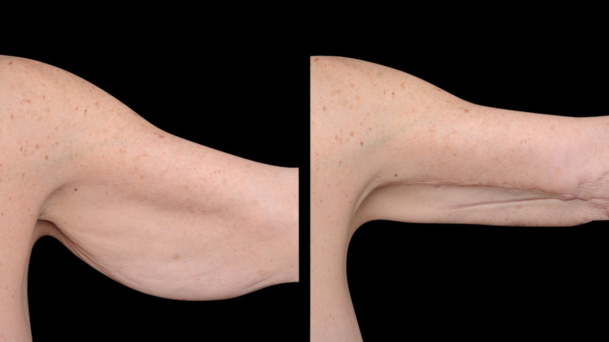 Arm Lift Before & After Gallery - Patient 263238 - Image 2
