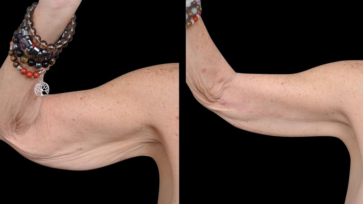 Arm Lift Before & After Gallery - Patient 263238 - Image 3