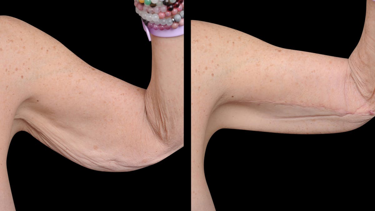 Arm Lift Before & After Gallery - Patient 263238 - Image 4
