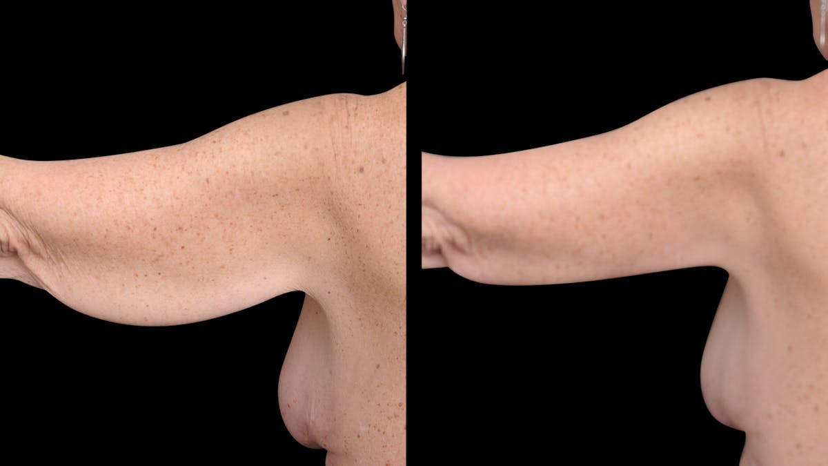 Arm Lift Before & After Gallery - Patient 263238 - Image 5