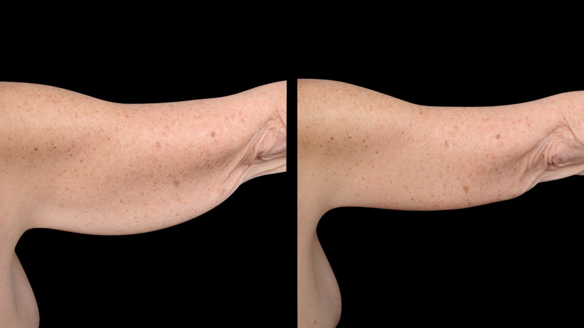 Arm Lift Before & After Gallery - Patient 263238 - Image 6