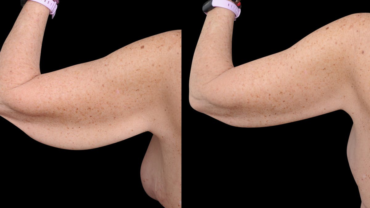 Arm Lift Before & After Gallery - Patient 263238 - Image 7