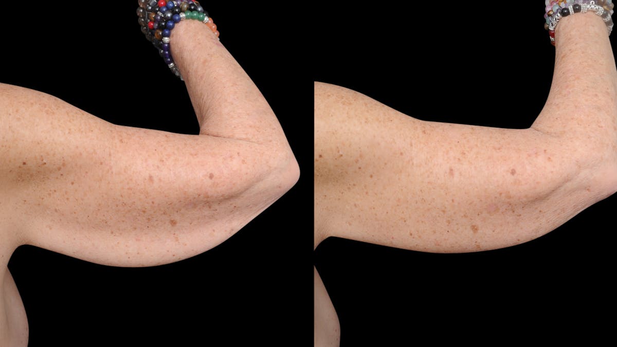 Arm Lift Before & After Gallery - Patient 263238 - Image 8