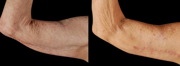 Arm Lift Before & After Gallery - Patient 374993 - Image 1