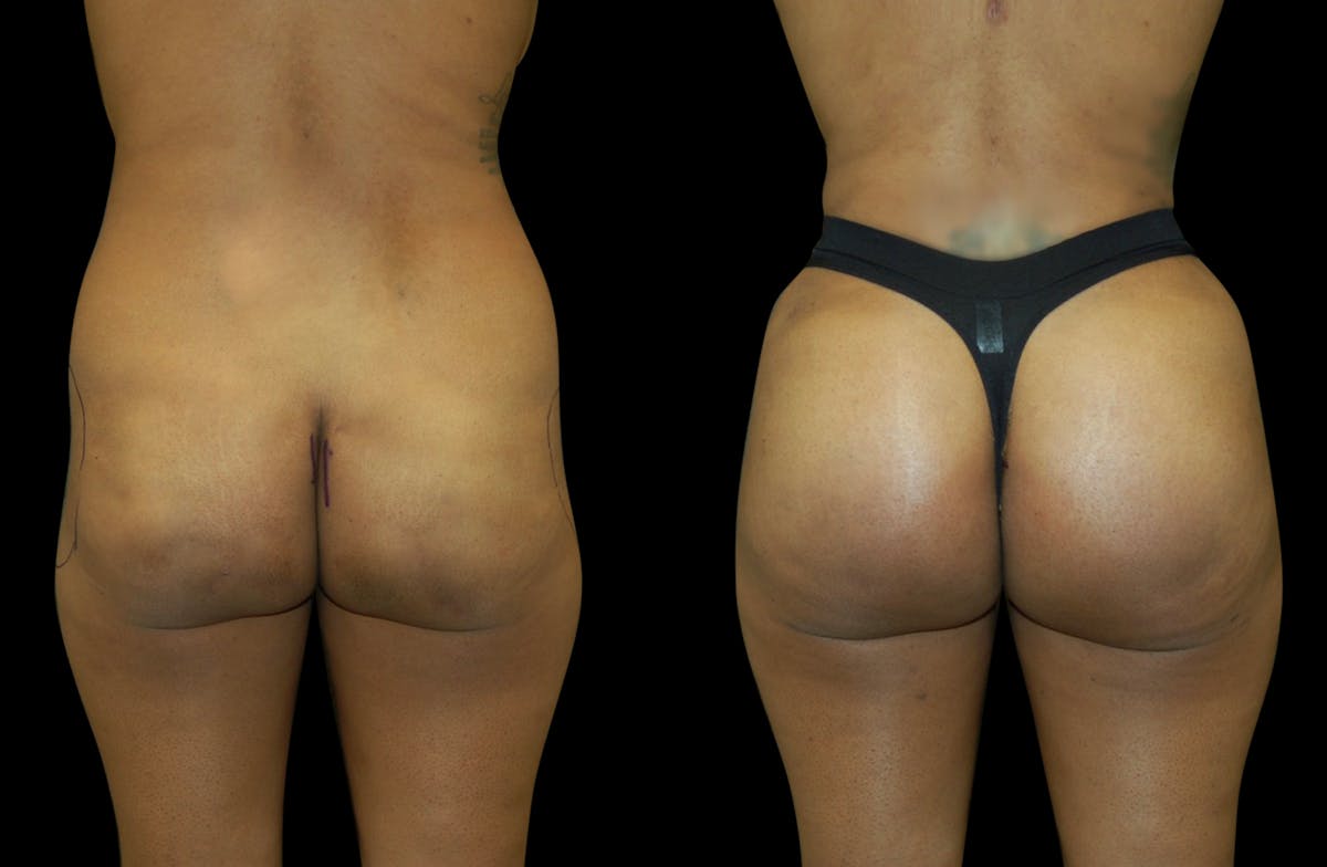 Brazilian Butt Lift Before & After Gallery - Patient 240322 - Image 1