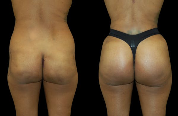 Brazilian Butt Lift Before & After Gallery - Patient 240322 - Image 1