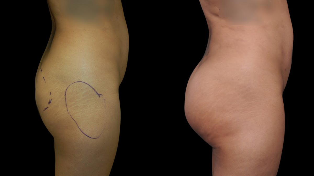 Brazilian Butt Lift Before & After Gallery - Patient 240322 - Image 3