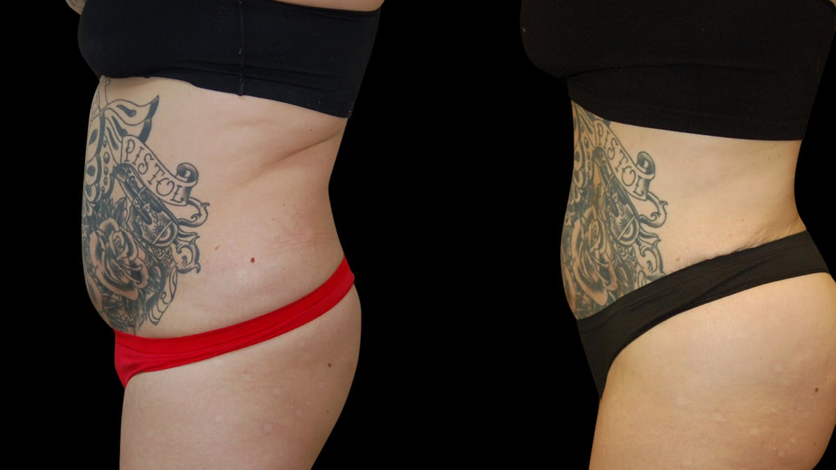 Brazilian Butt Lift Before & After Gallery - Patient 172975 - Image 2