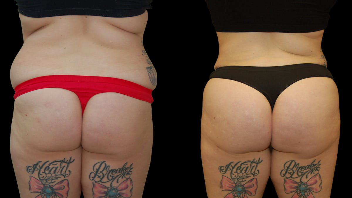 Brazilian Butt Lift Before & After Gallery - Patient 172975 - Image 1