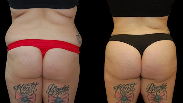 Brazilian Butt Lift Before & After Gallery - Patient 172975 - Image 1