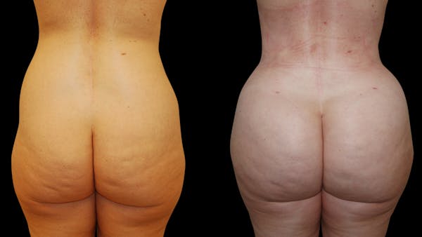 Brazilian Butt Lift Before & After Gallery - Patient 422965 - Image 1