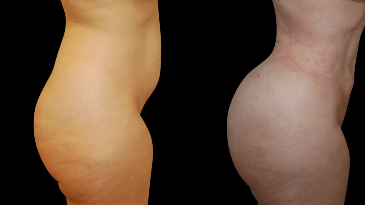 Brazilian Butt Lift Before & After Gallery - Patient 422965 - Image 2