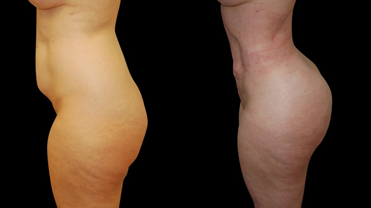 Brazilian Butt Lift Before & After Gallery - Patient 422965 - Image 3