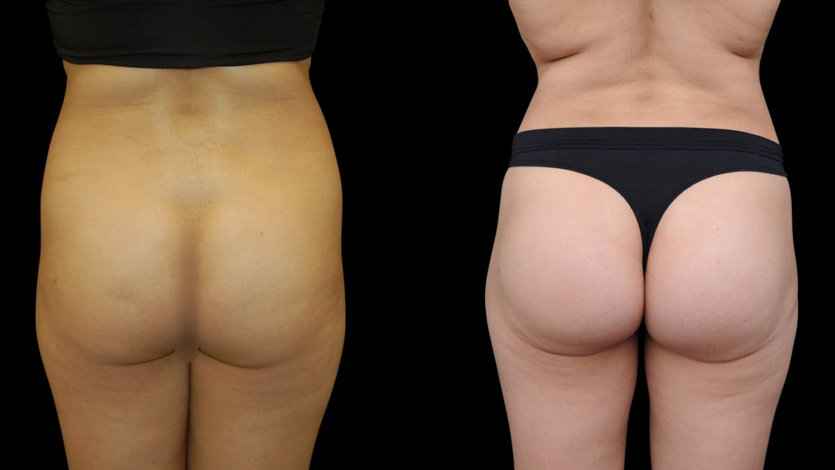 Butt Implants Before & After Gallery - Patient 326398 - Image 1