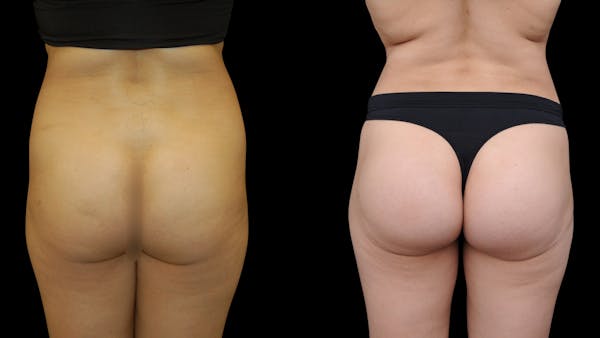 Butt Implants Before & After Gallery - Patient 326398 - Image 1