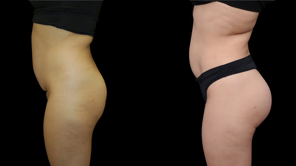 Butt Implants Before & After Gallery - Patient 326398 - Image 2