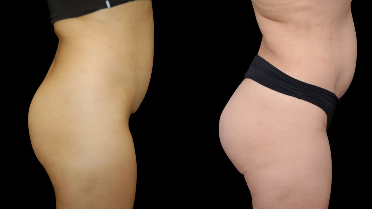 Butt Implants Before & After Gallery - Patient 326398 - Image 3