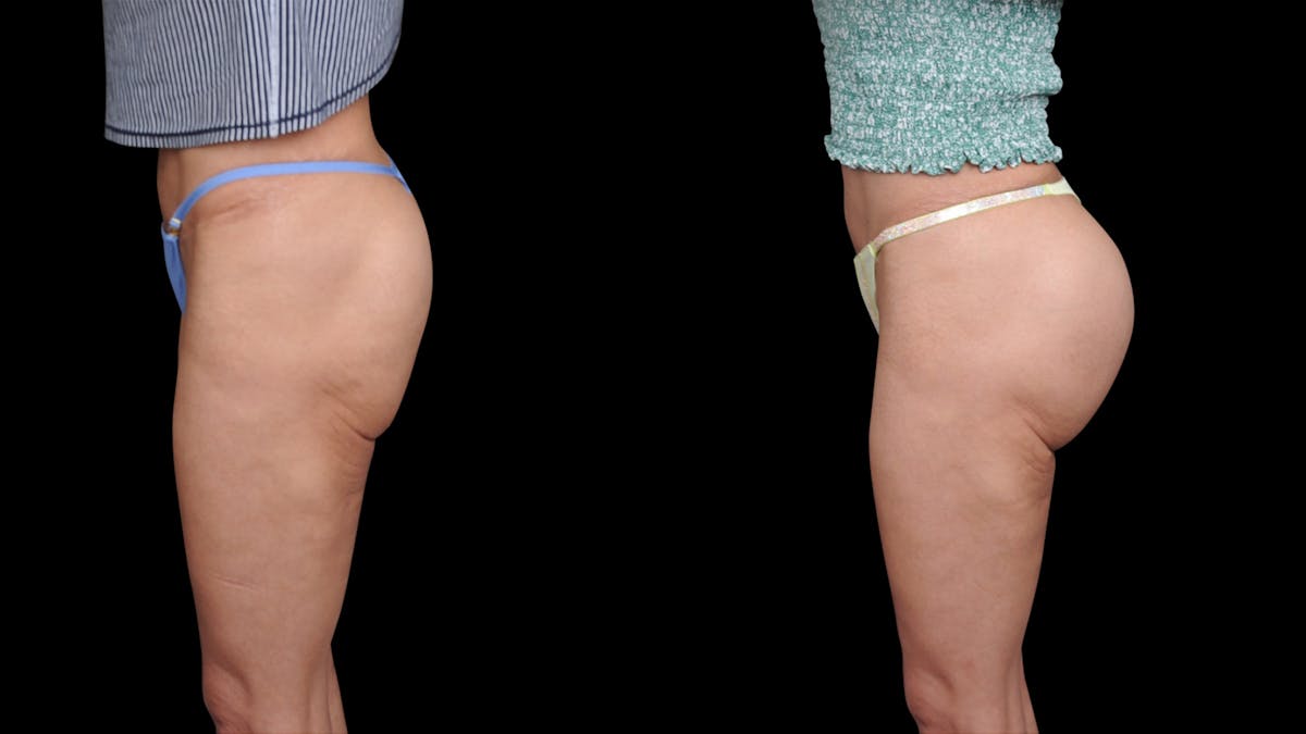 Butt Implants Before & After Gallery - Patient 103673 - Image 2