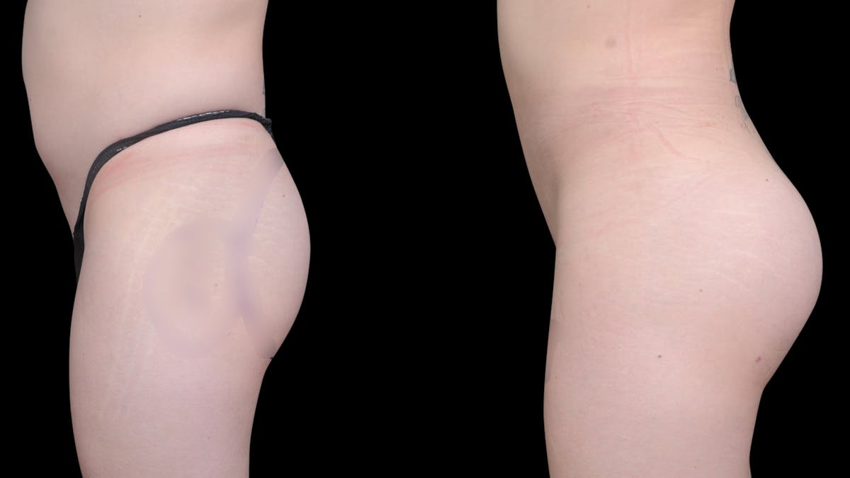 Butt Implants Before & After Gallery - Patient 290540 - Image 3