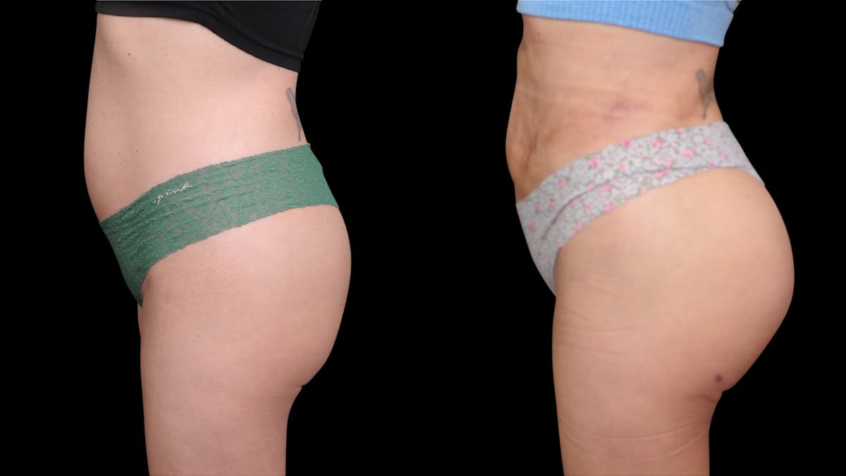 Butt Implants Before & After Gallery - Patient 340795 - Image 1