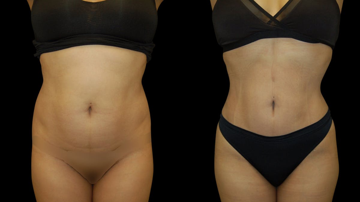 Butt Implants Before & After Gallery - Patient 165350 - Image 3