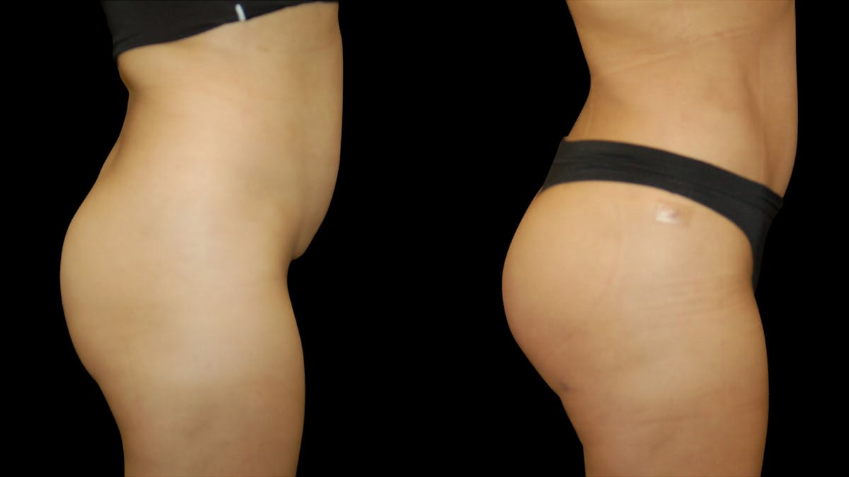 Butt Implants Before & After Gallery - Patient 165350 - Image 2