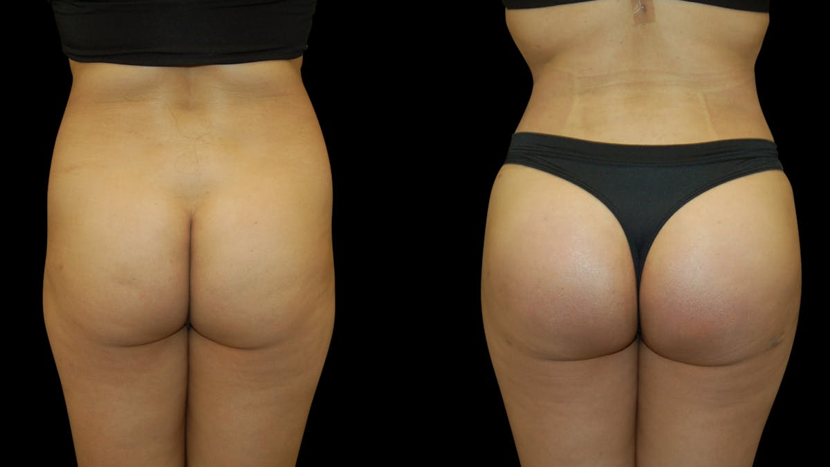 Butt Implants Before & After Gallery - Patient 165350 - Image 1