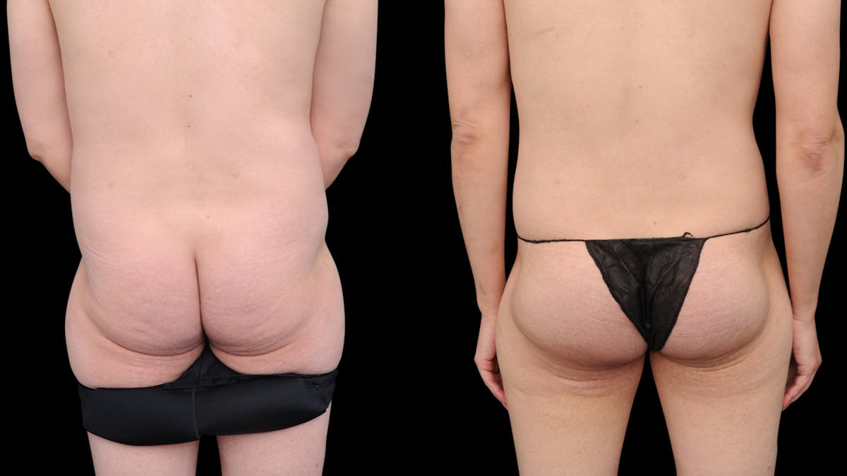 Butt Implants Before & After Gallery - Patient 145313 - Image 1