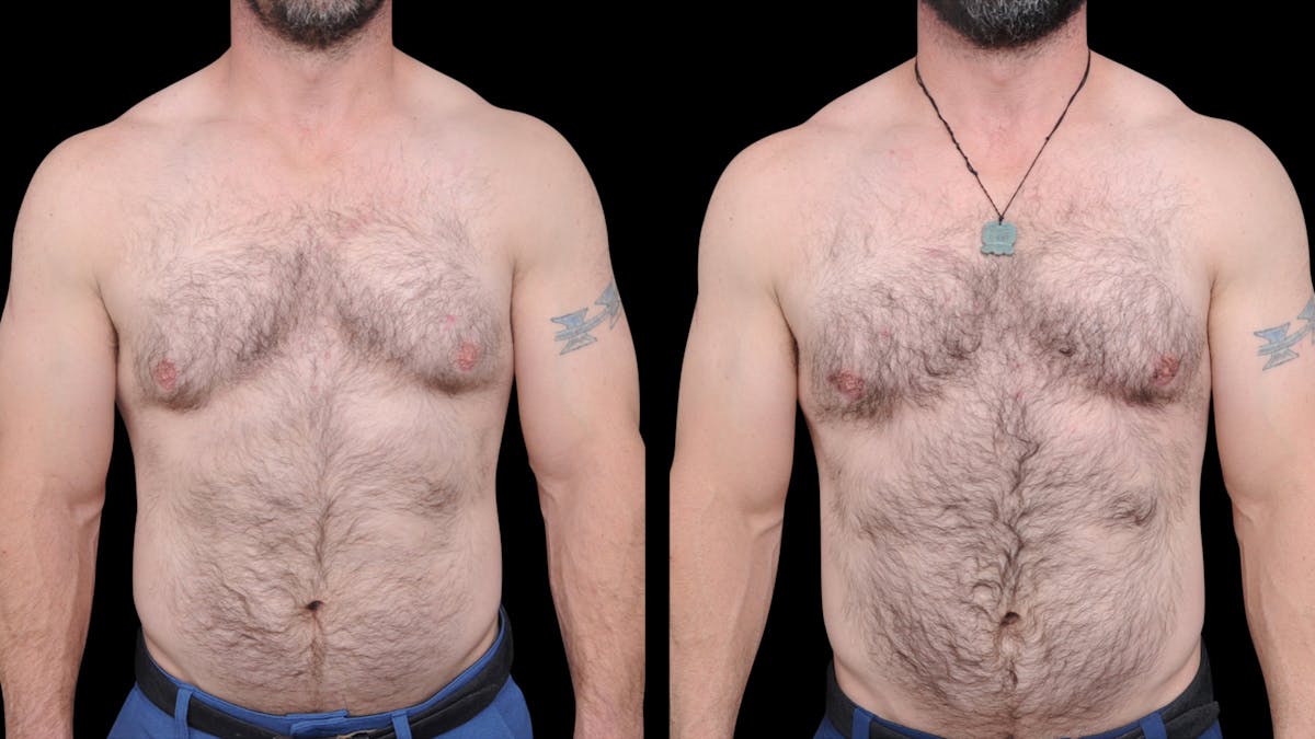 Gynecomastia Before & After Gallery - Patient 224293 - Image 1