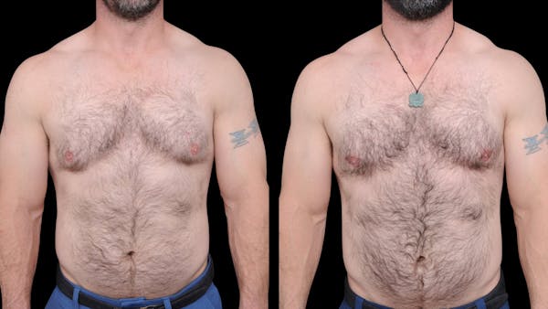 Gynecomastia Before & After Gallery - Patient 224293 - Image 1