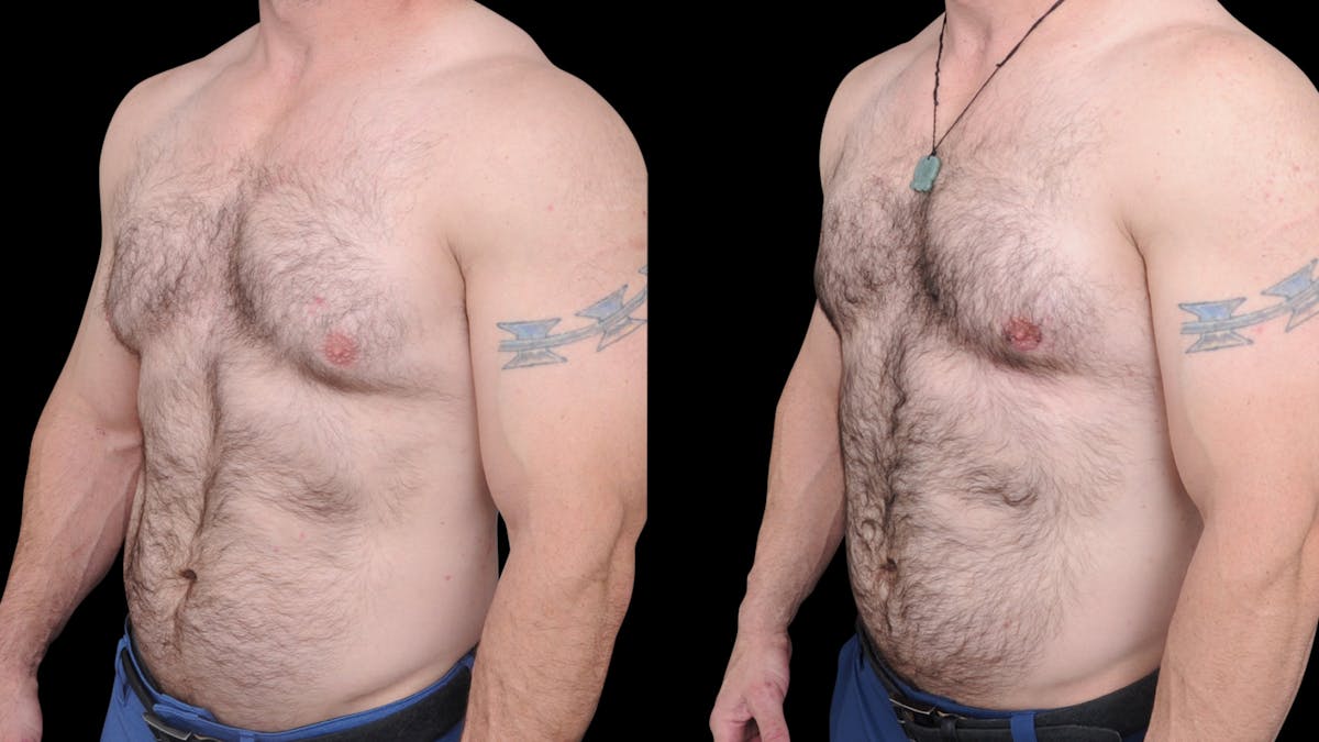 Gynecomastia Before & After Gallery - Patient 224293 - Image 2