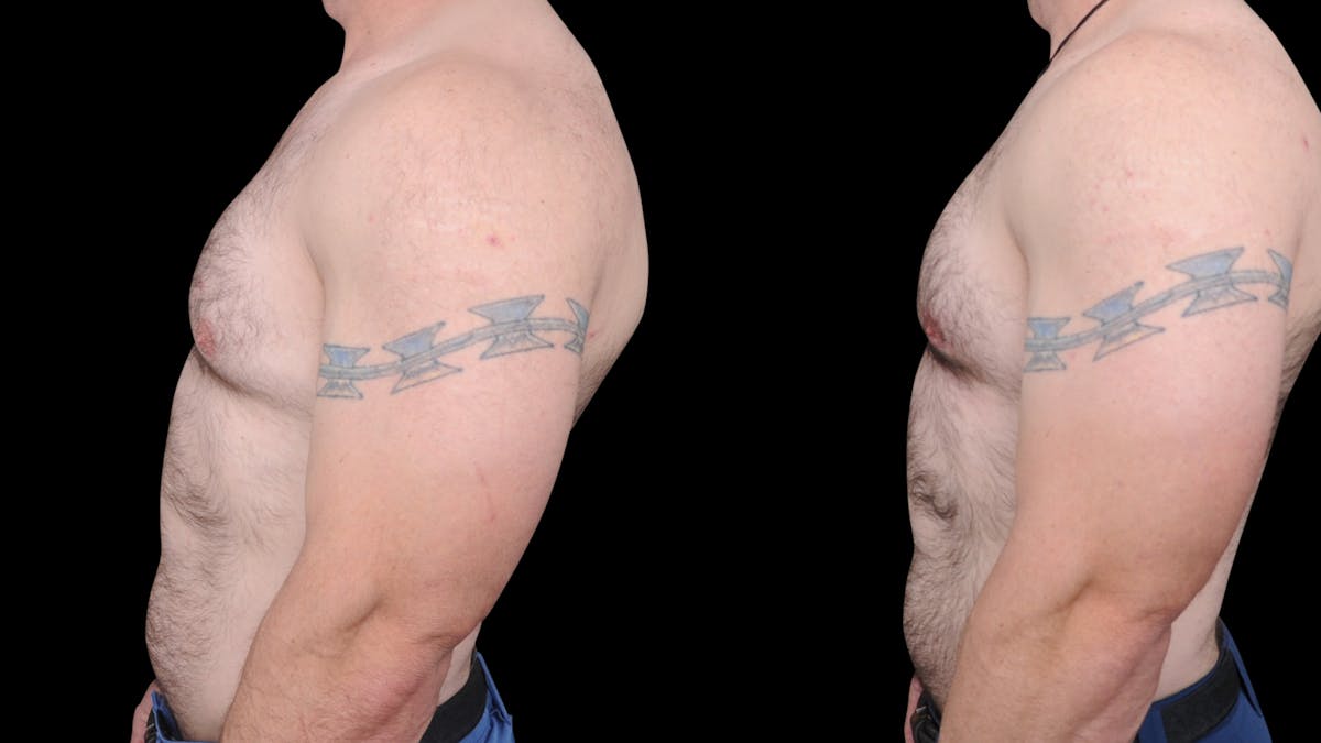 Gynecomastia Before & After Gallery - Patient 224293 - Image 3