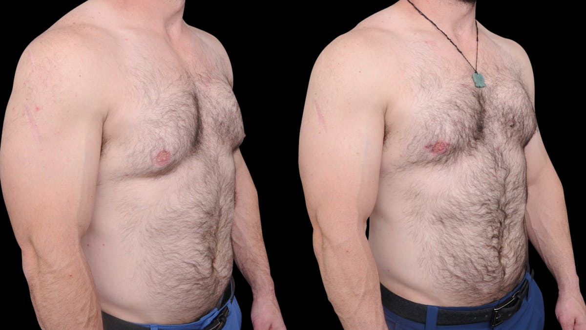 Gynecomastia Before & After Gallery - Patient 224293 - Image 4