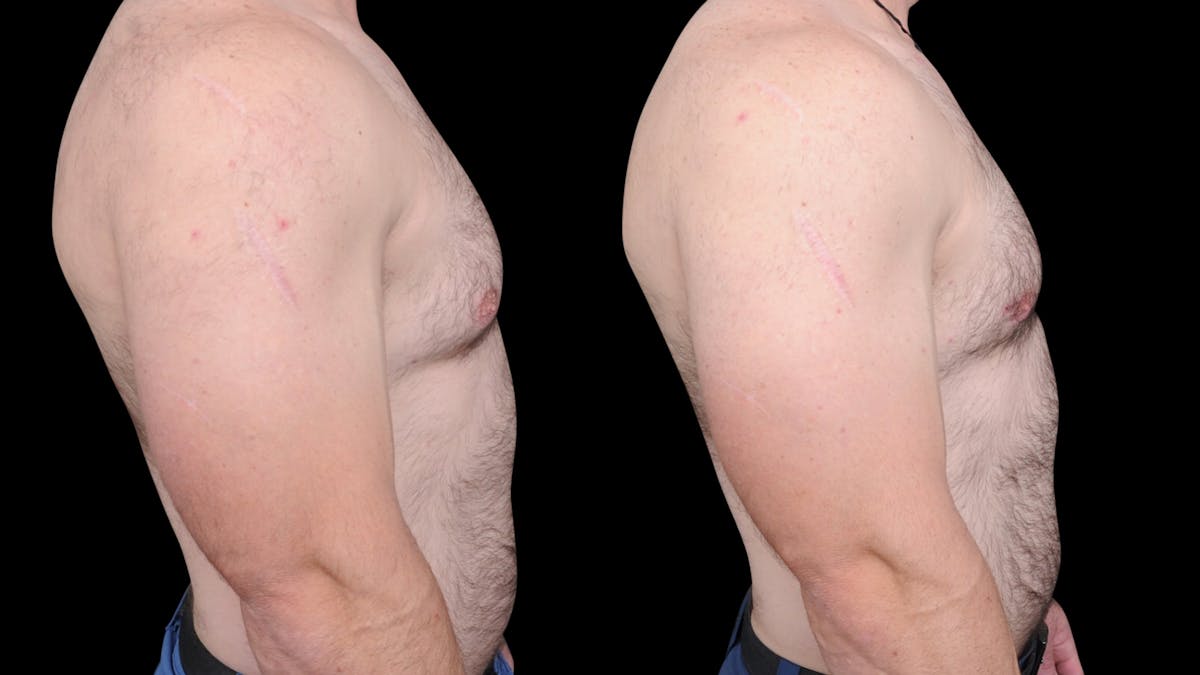 Gynecomastia Before & After Gallery - Patient 224293 - Image 5