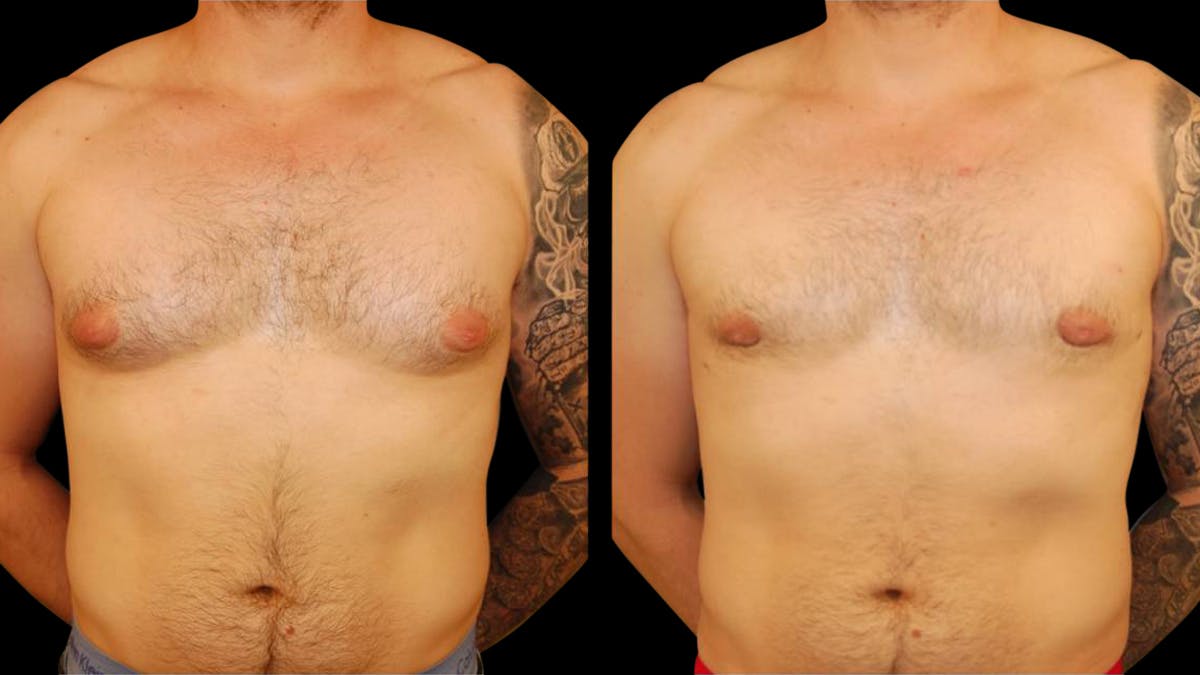 Gynecomastia Before & After Gallery - Patient 145053 - Image 1
