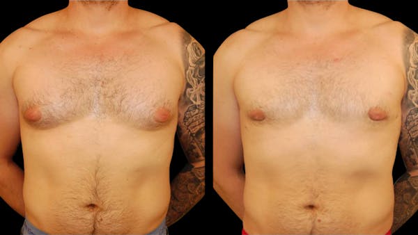 Gynecomastia Before & After Gallery - Patient 145053 - Image 1