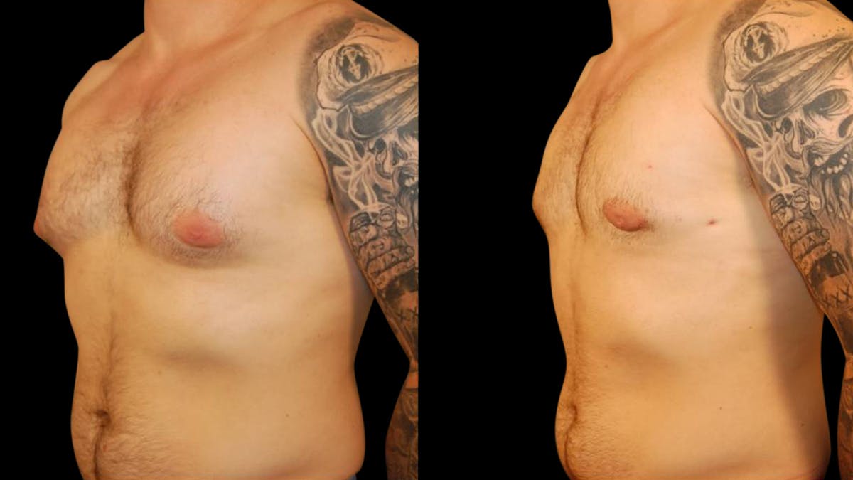Gynecomastia Before & After Gallery - Patient 145053 - Image 2