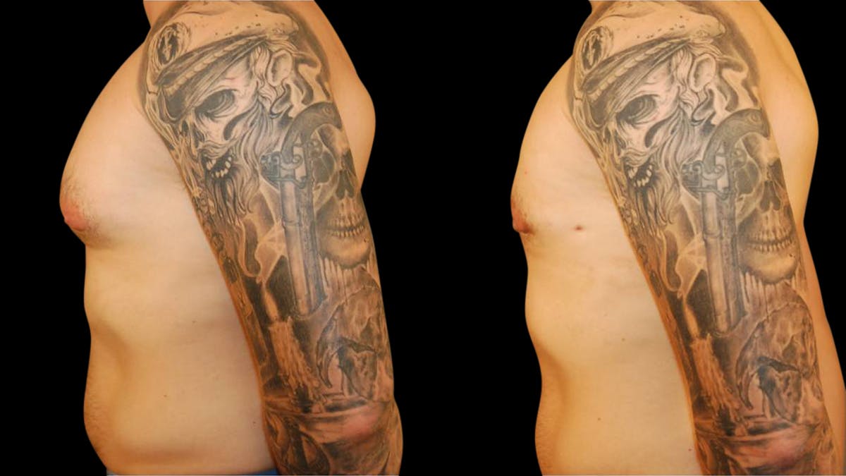 Gynecomastia Before & After Gallery - Patient 145053 - Image 3