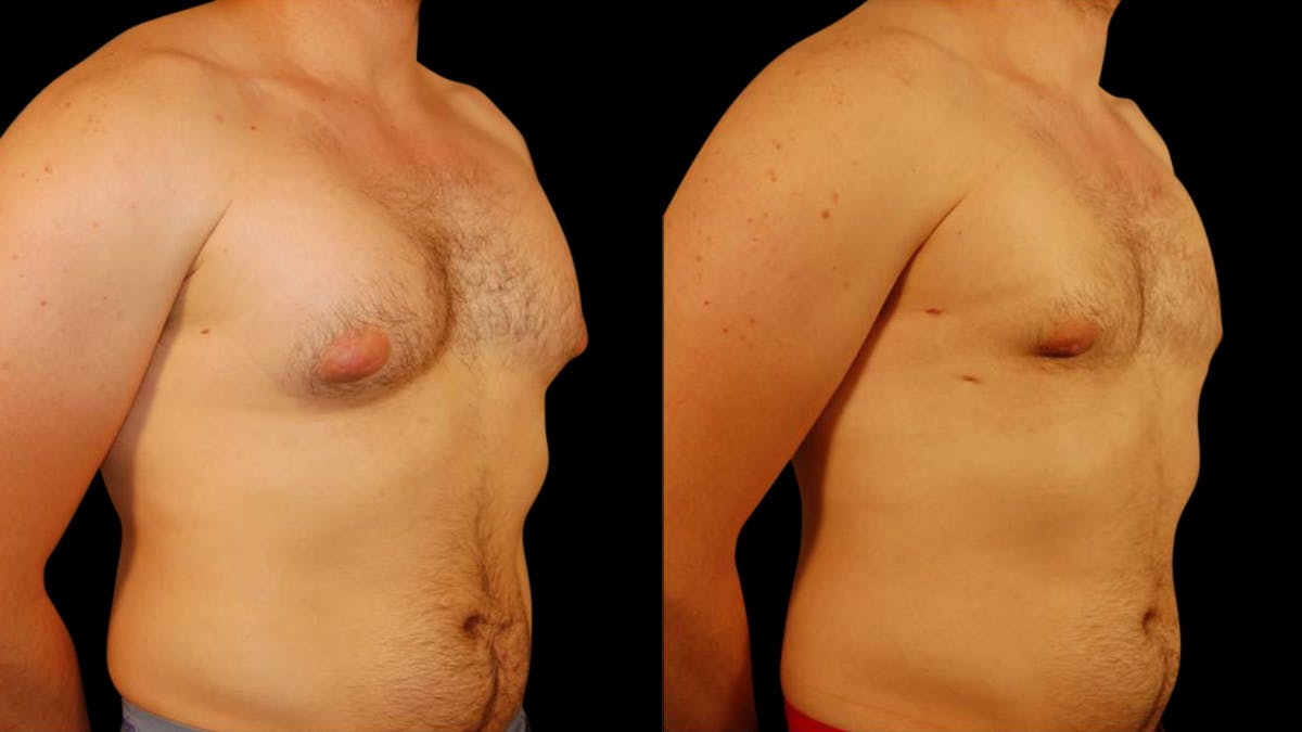 Gynecomastia Before & After Gallery - Patient 145053 - Image 4