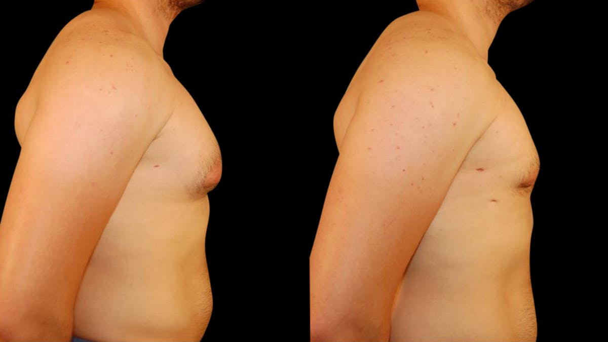 Gynecomastia Before & After Gallery - Patient 145053 - Image 5